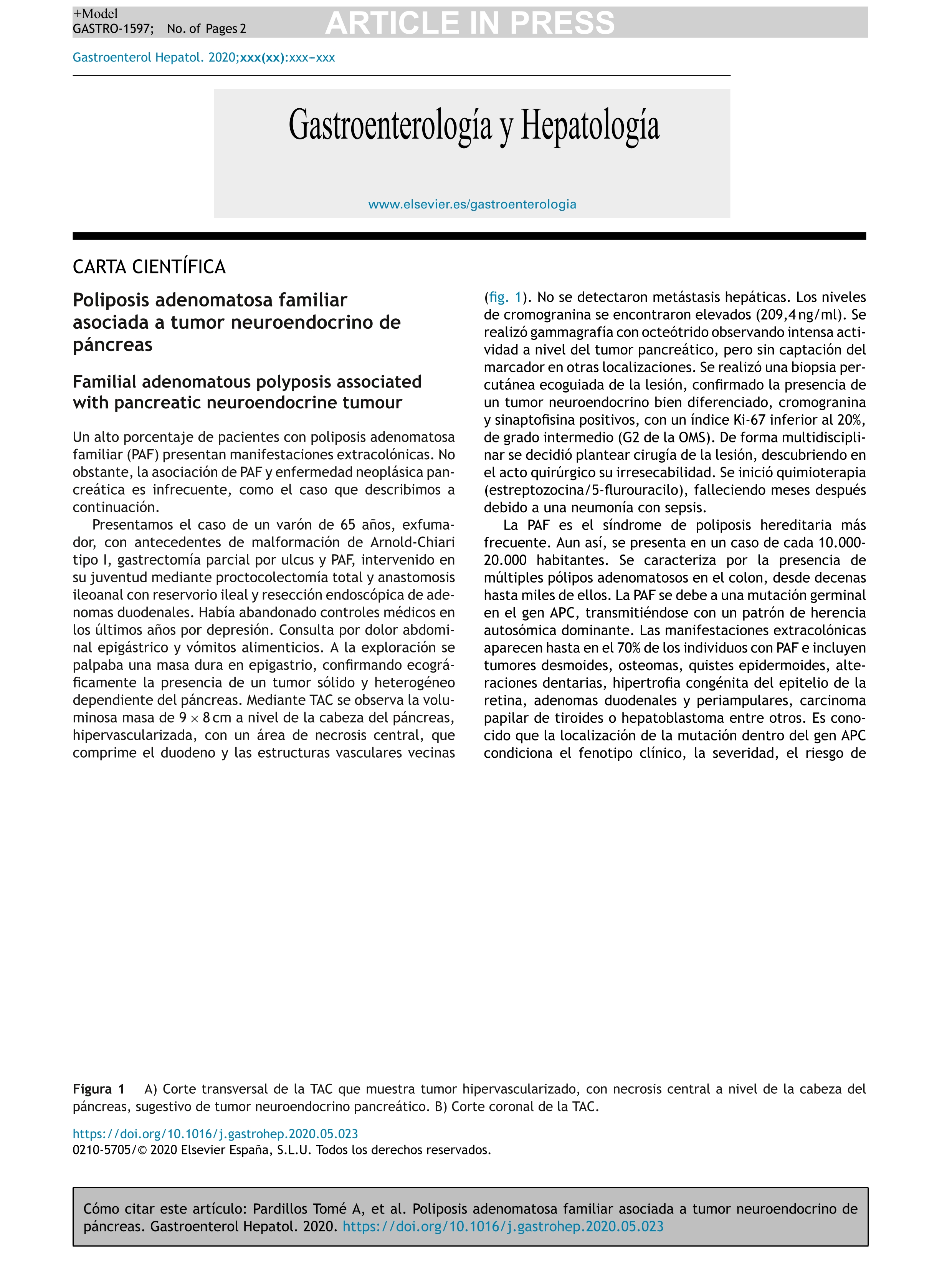 Poliposis adenomatosa familiar asociada a tumor neuroendocrino de páncreas