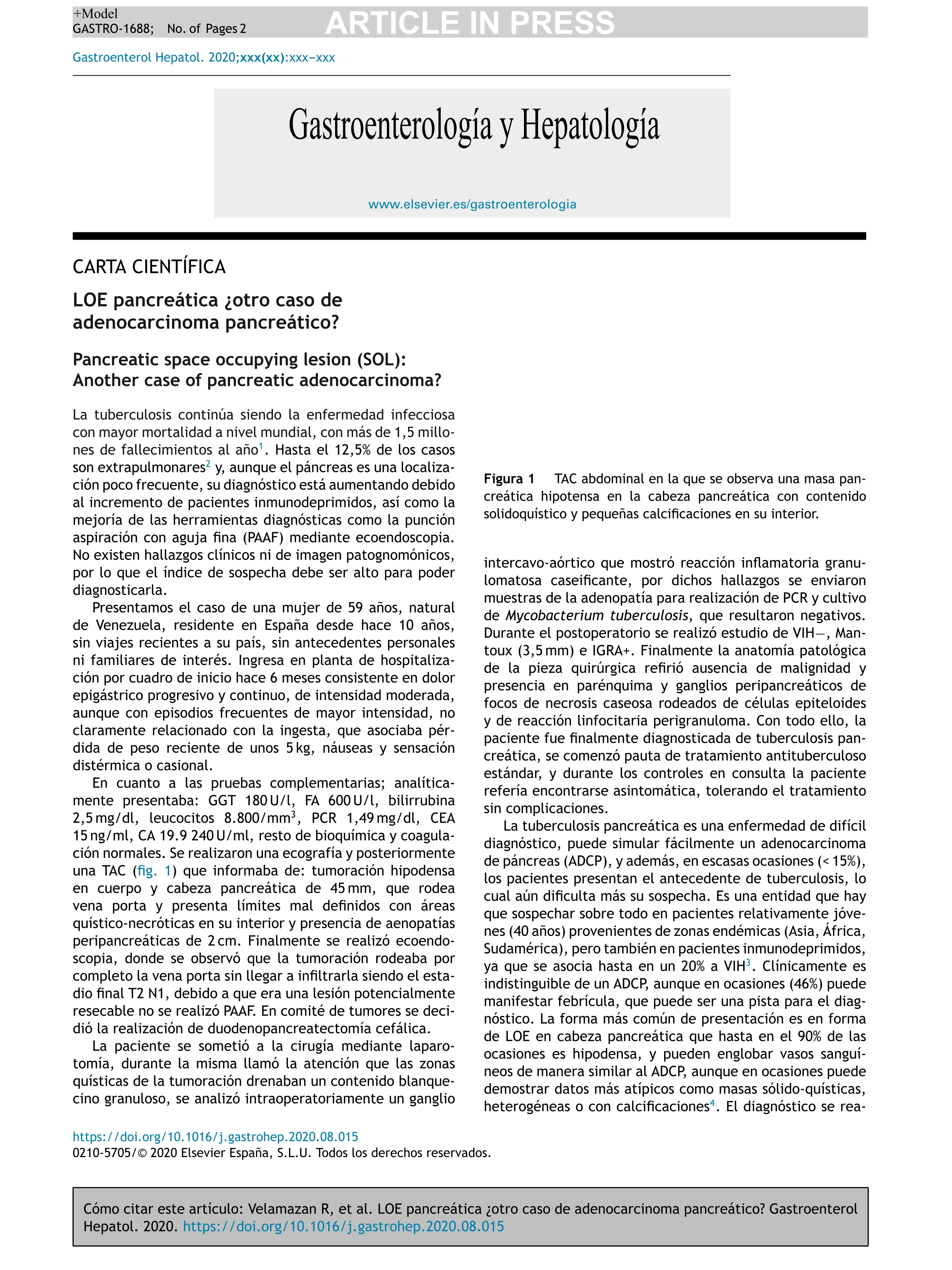 LOE pancreática ¿otro caso de adenocarcinoma pancreático?