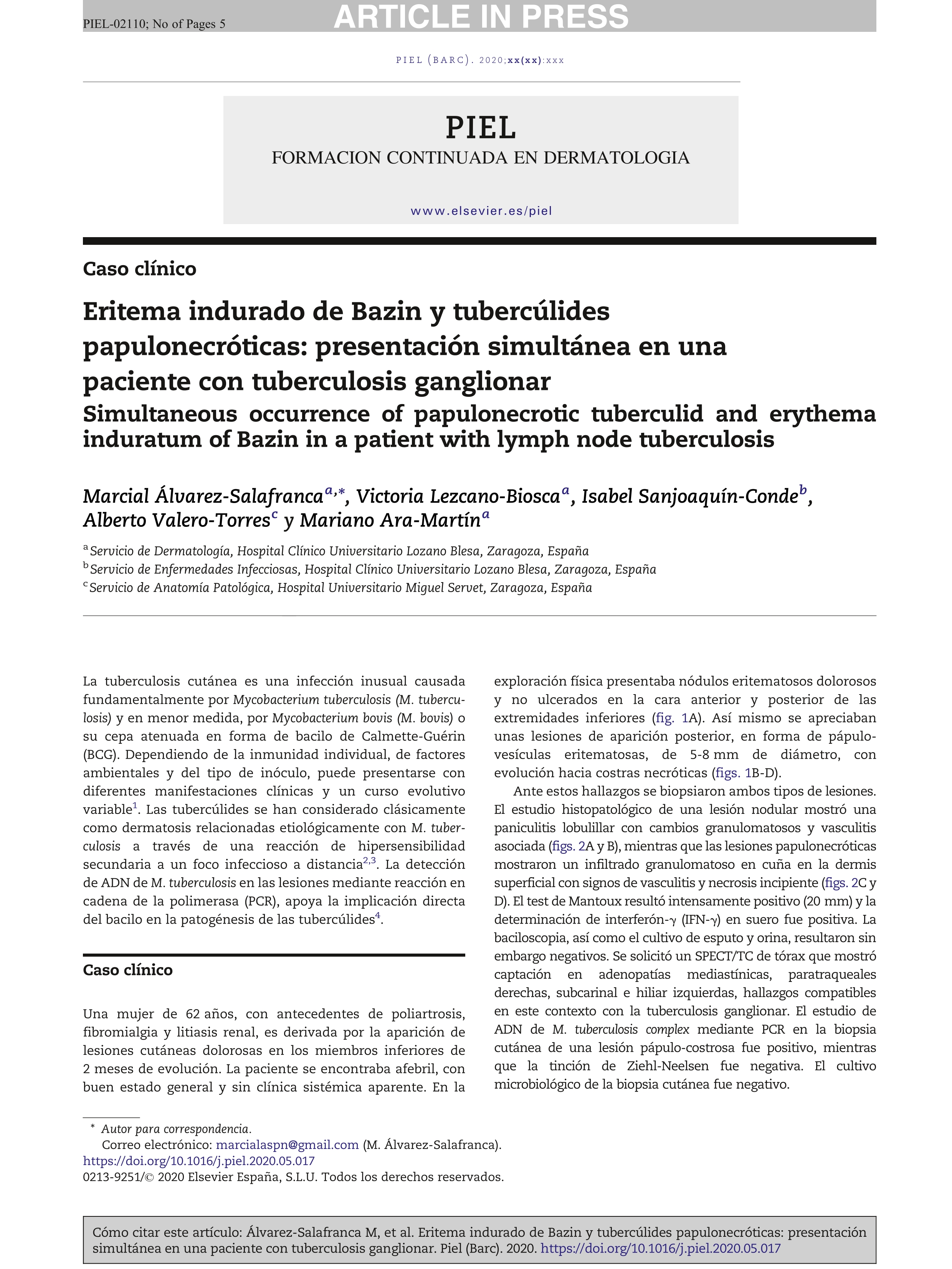 Eritema indurado de Bazin y tubercúlides papulonecróticas: presentación simultánea en una paciente con tuberculosis ganglionar
