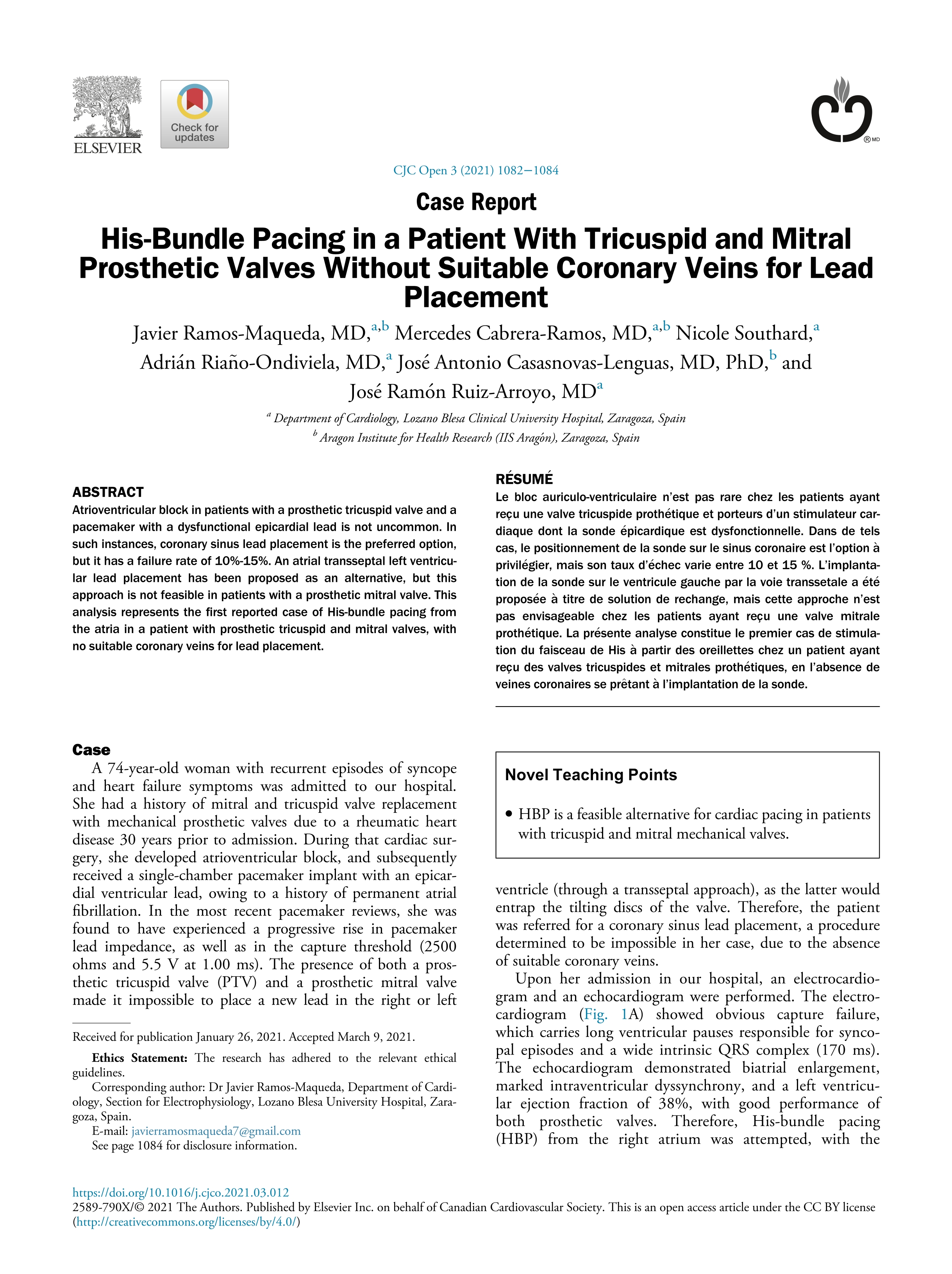 His-Bundle Pacing in a Patient With Tricuspid and Mitral Prosthetic Valves Without Suitable Coronary Veins for Lead Placement