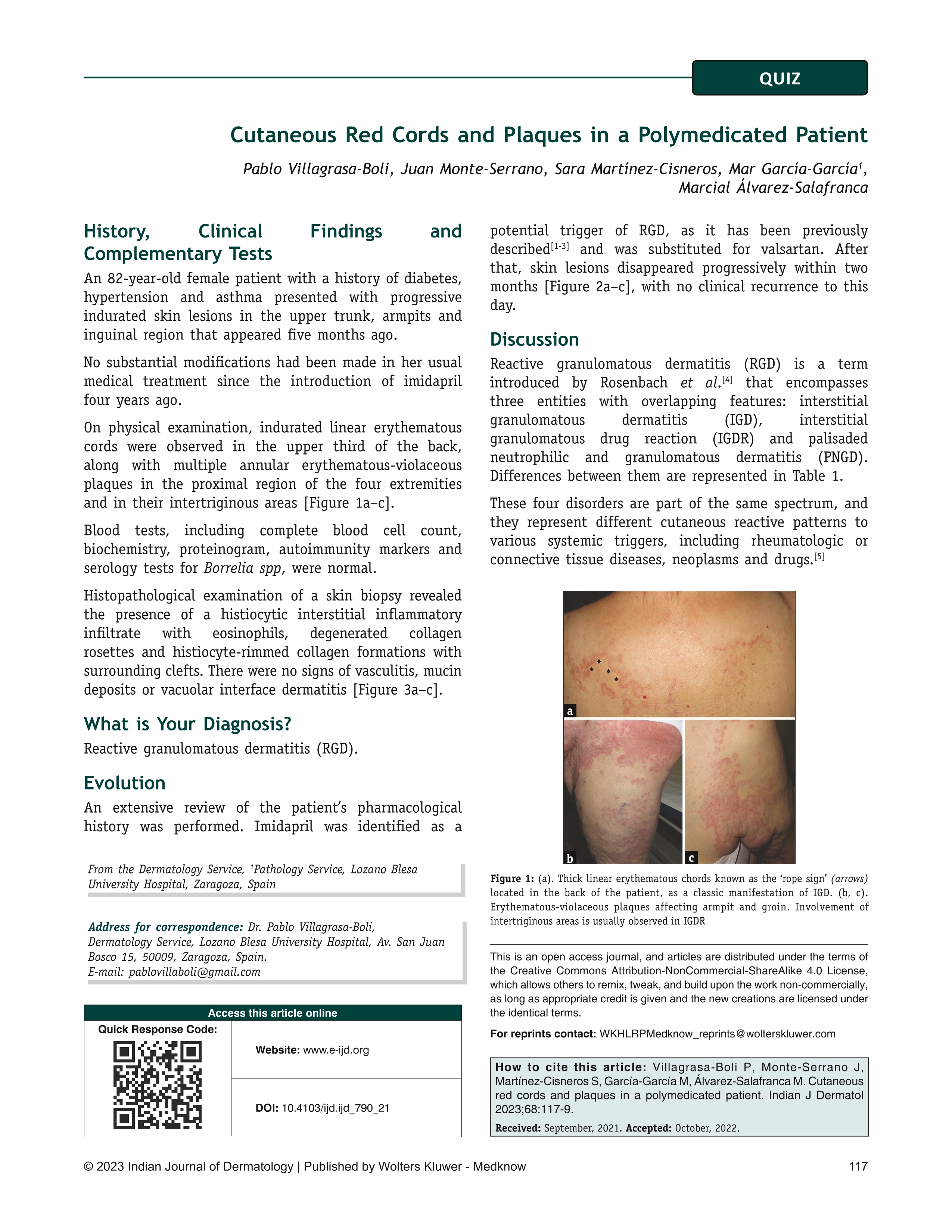 Cutaneous Red Cords and Plaques in a Polymedicated Patient