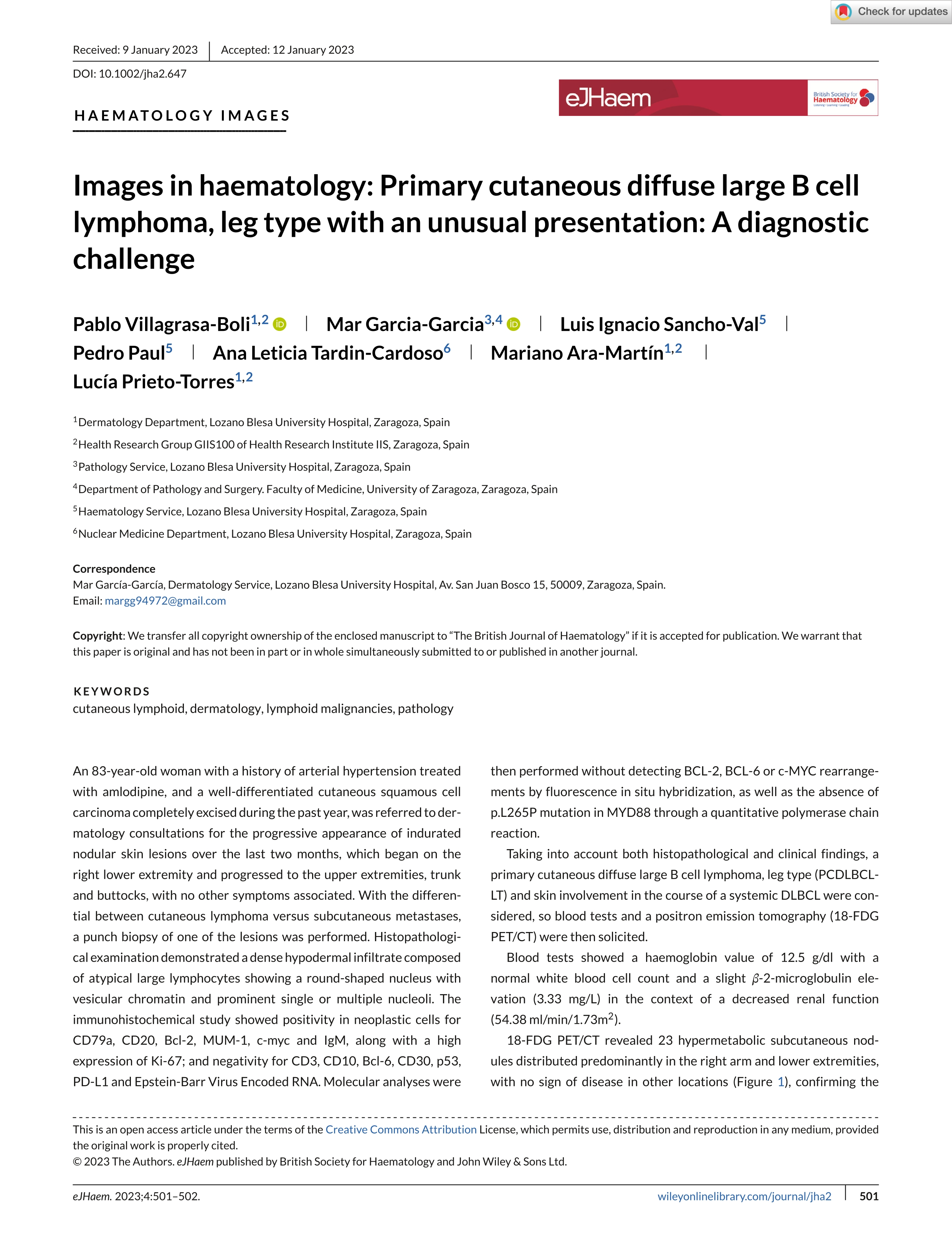 Images in haematology: Primary cutaneous diffuse large B cell lymphoma, leg type with an unusual presentation: A diagnostic challenge