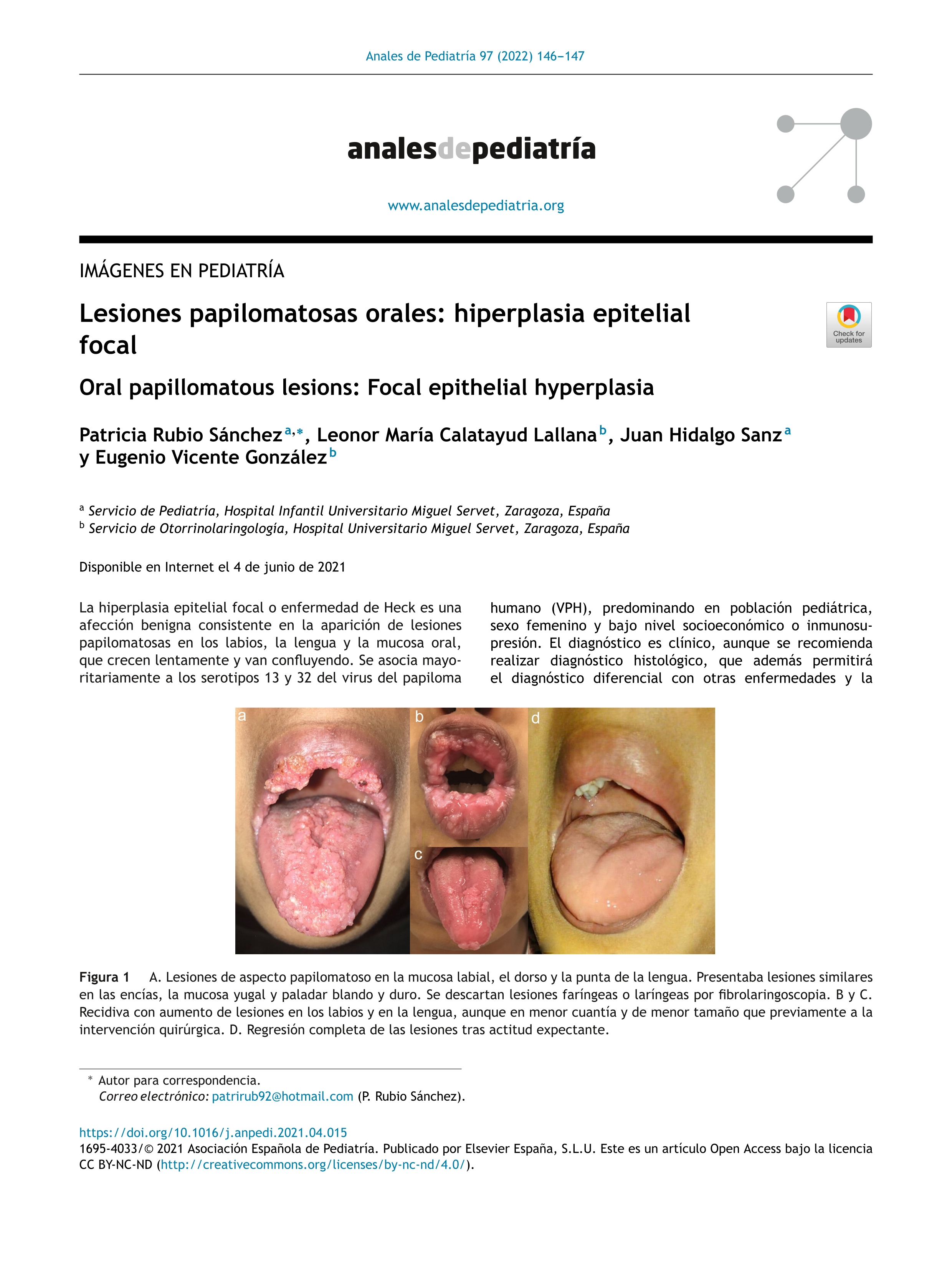 Lesiones papilomatosas orales: hiperplasia epitelial focal