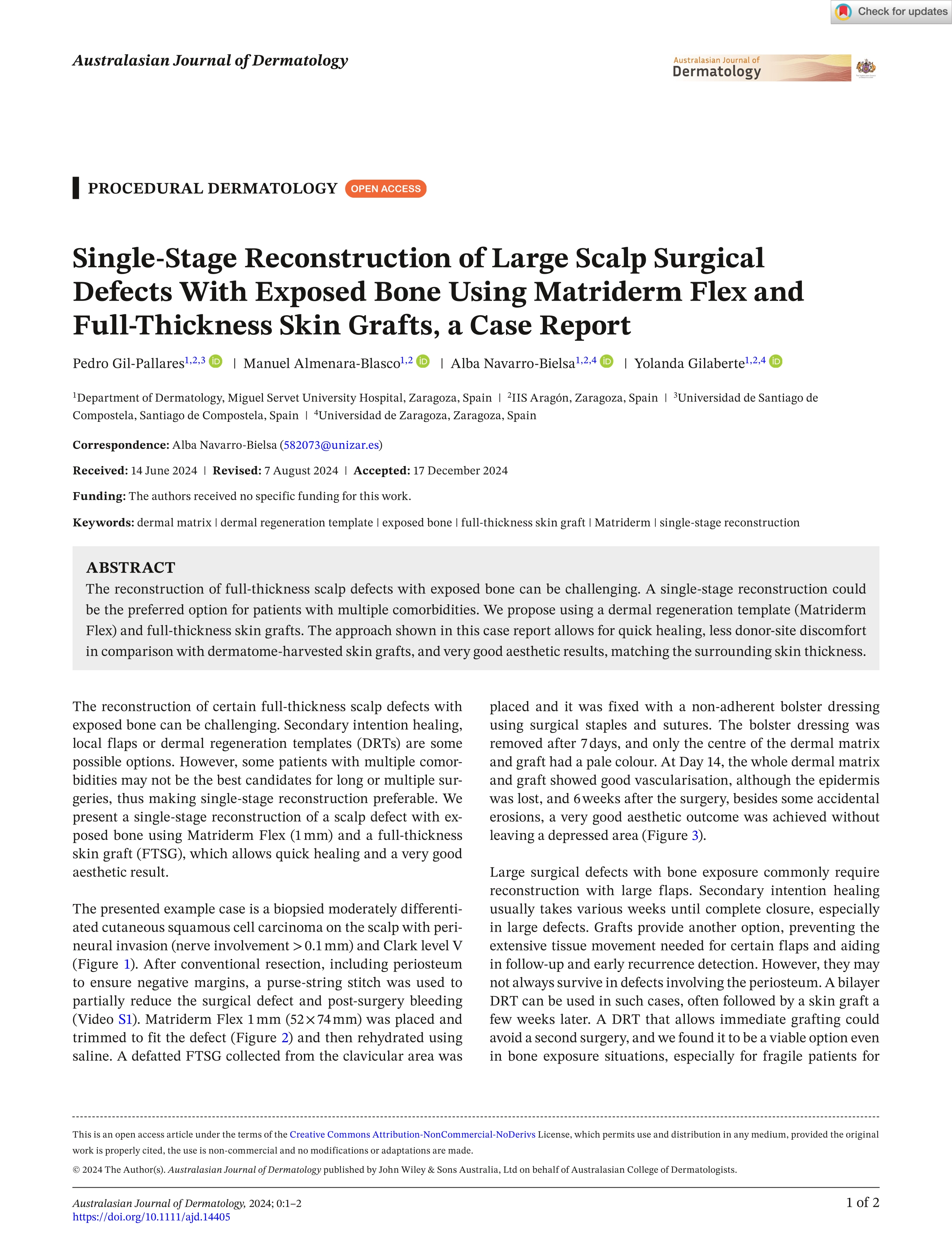 Single-Stage Reconstruction of Large Scalp Surgical Defects With Exposed Bone Using Matriderm Flex and Full-Thickness Skin Grafts, a Case Report