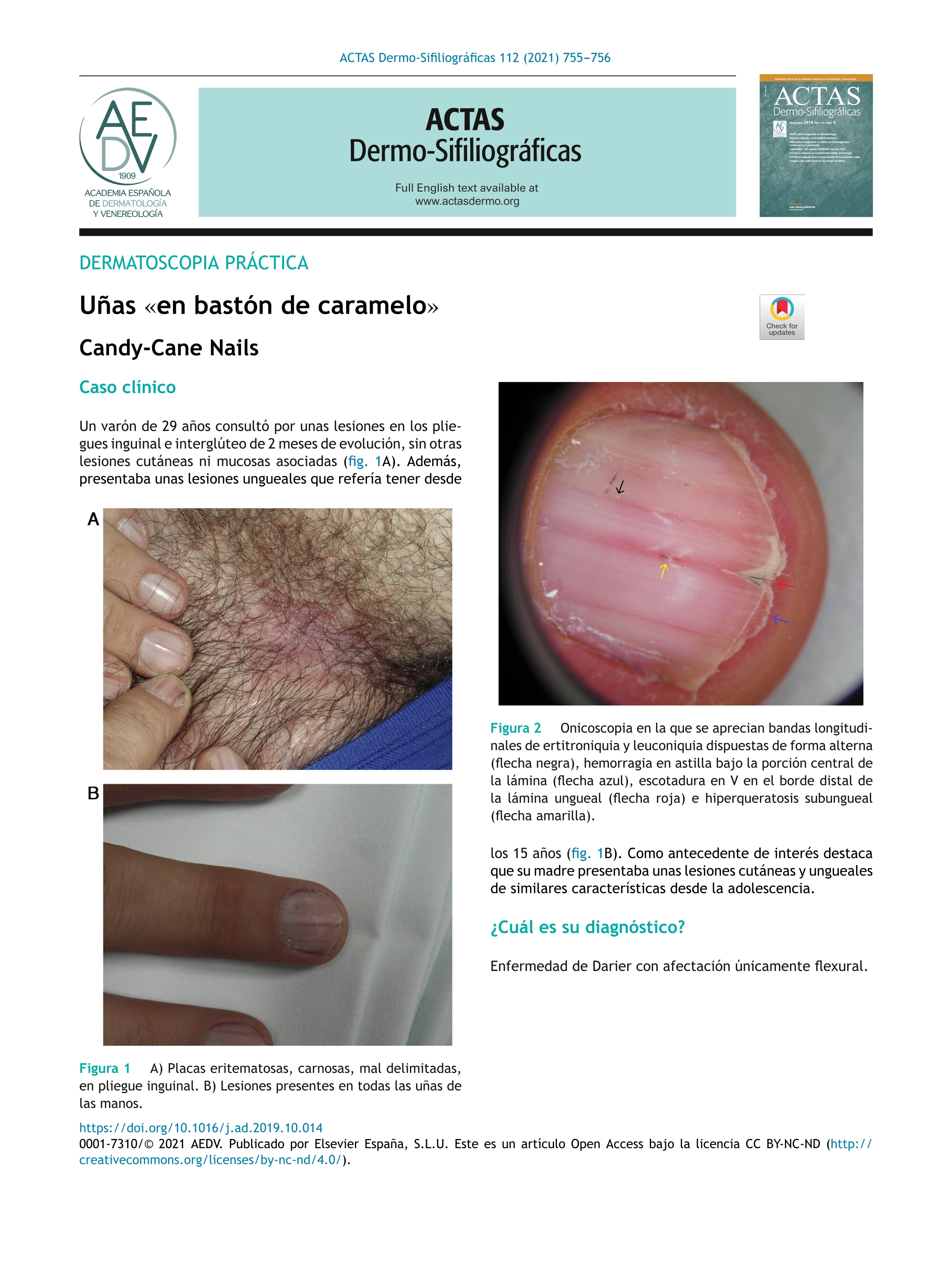 Candy-Cane Nails [Uñas «en bastón de caramelo»]