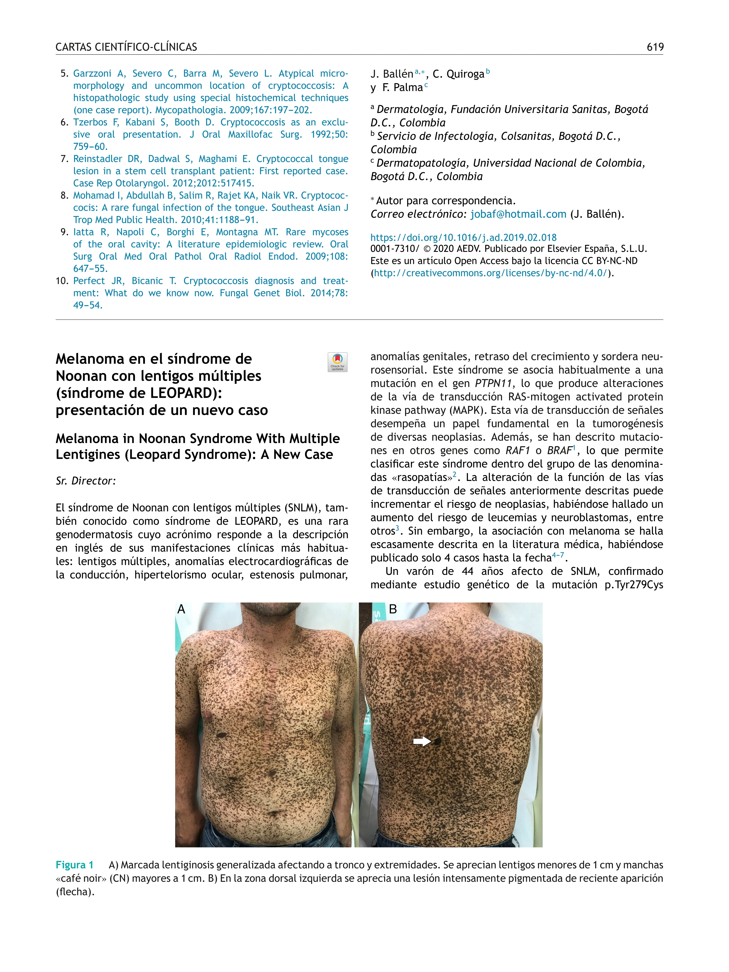 Melanoma in Noonan Syndrome With Multiple Lentigines (Leopard Syndrome): A New Case [Melanoma en el síndrome de Noonan con lentigos múltiples (síndrome de LEOPARD): presentación de un nuevo caso]