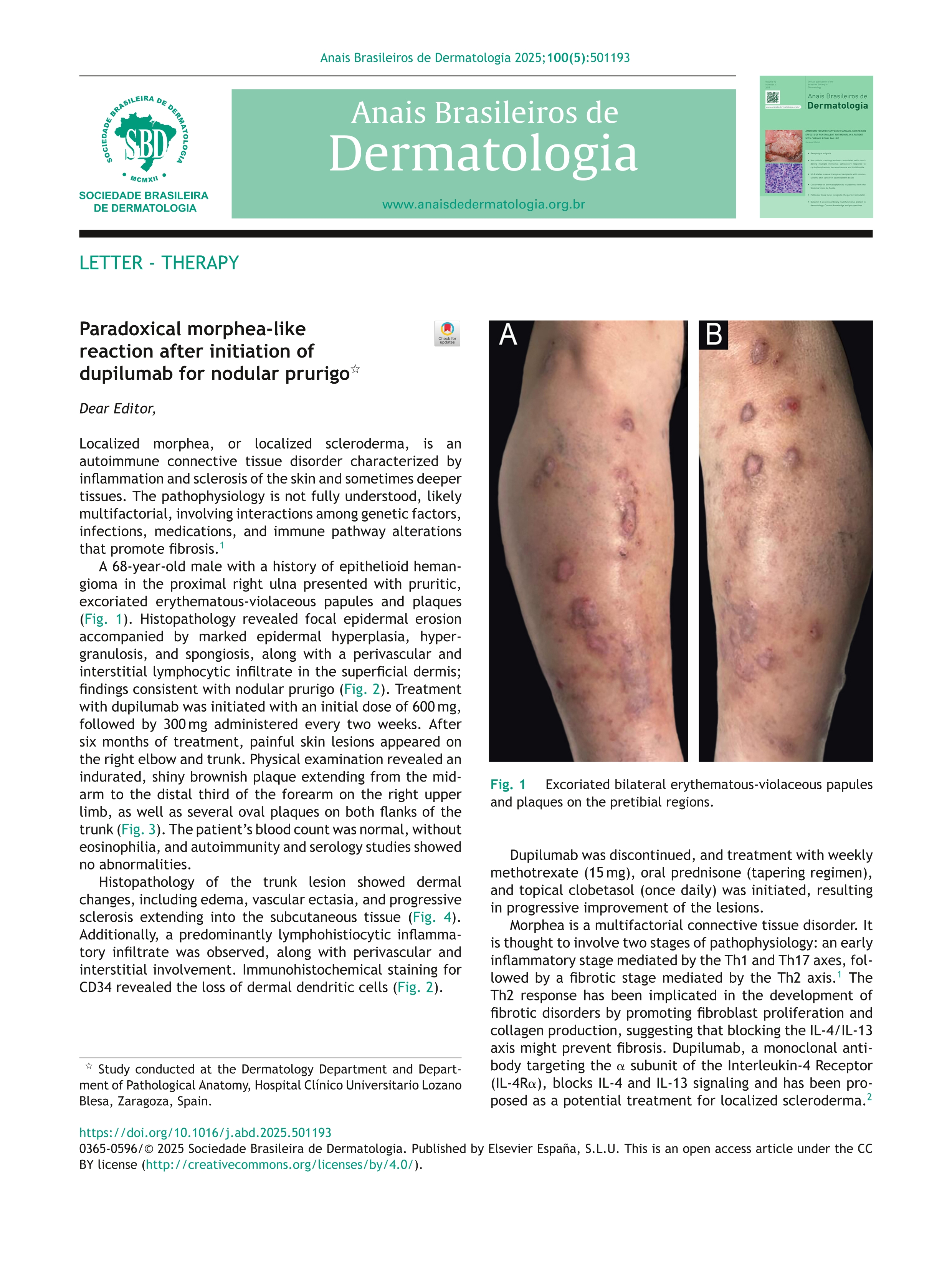 Paradoxical morphea-like reaction after initiation of dupilumab for nodular prurigo