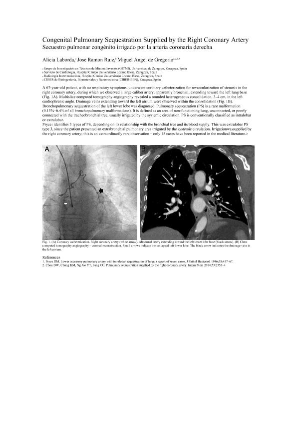 Congenital Pulmonary Sequestration Supplied by the Right Coronary Artery