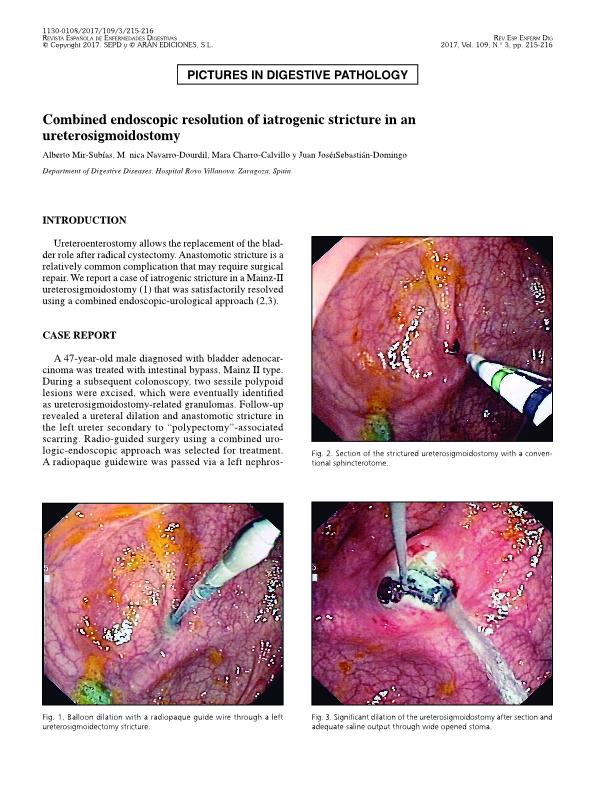 Combined endoscopic resolution of iatrogenic stricture in an ureterosigmoidostomy