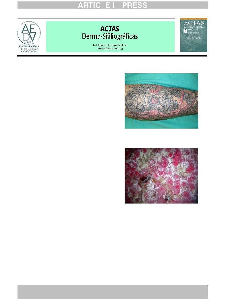 Hiperplasia seudoepiteliomatosa: una reacción infrecuente de los tatuajes