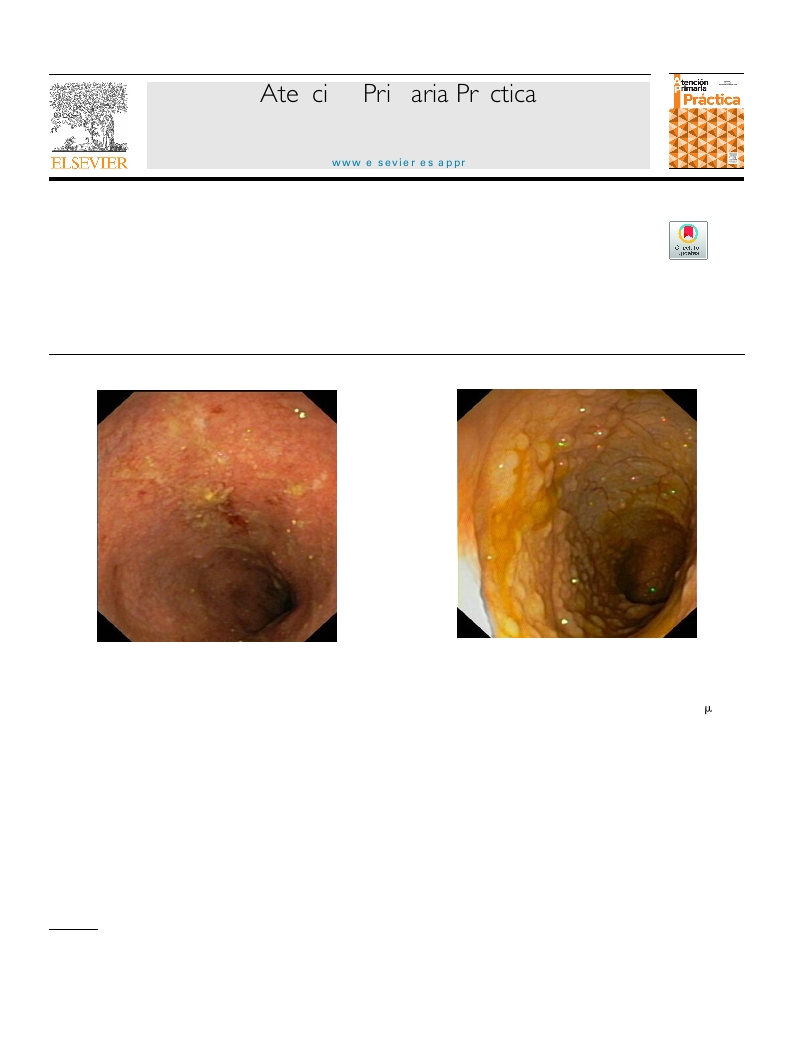 Diarrea y anemia en la infancia: ¿y si es una enfermedad inflamatoria intestinal?