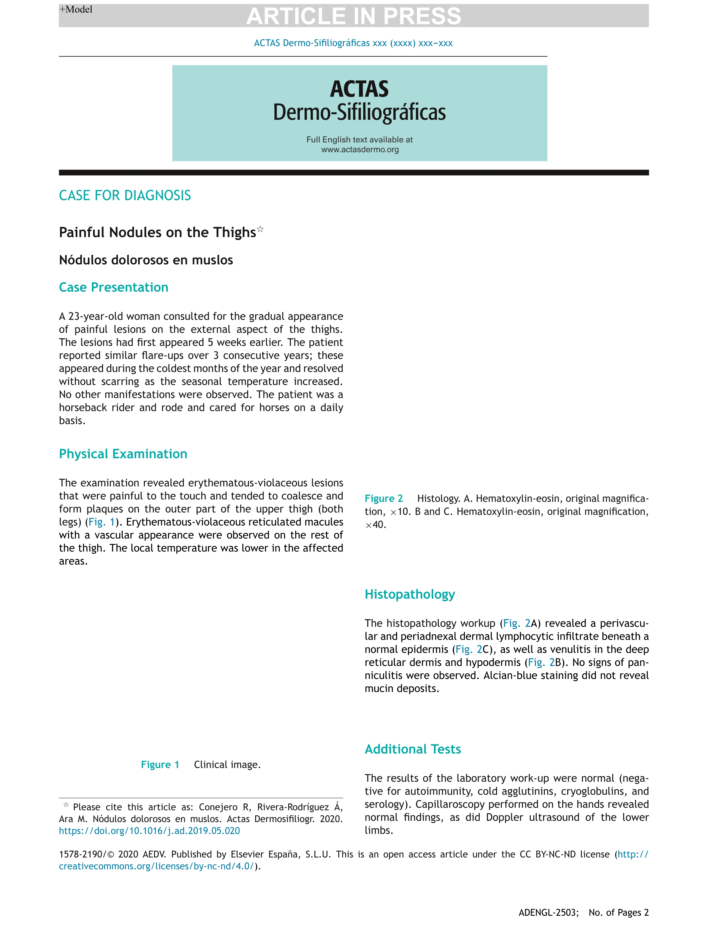Painful Nodules on the Thighs